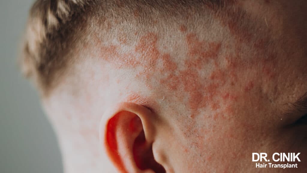 Seborrheic Dermatitis and Hair Transplant: Everything You Need to Know