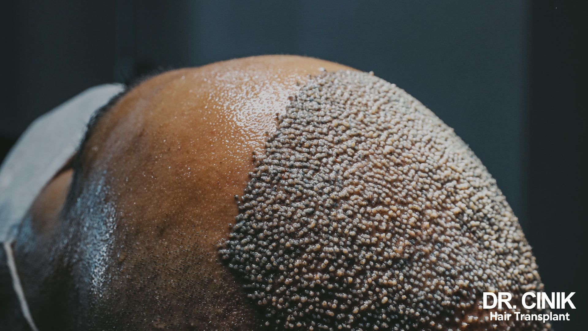 Close-up of the top of a head just after implantation, grafts in neat rows and the area glistening with moisture