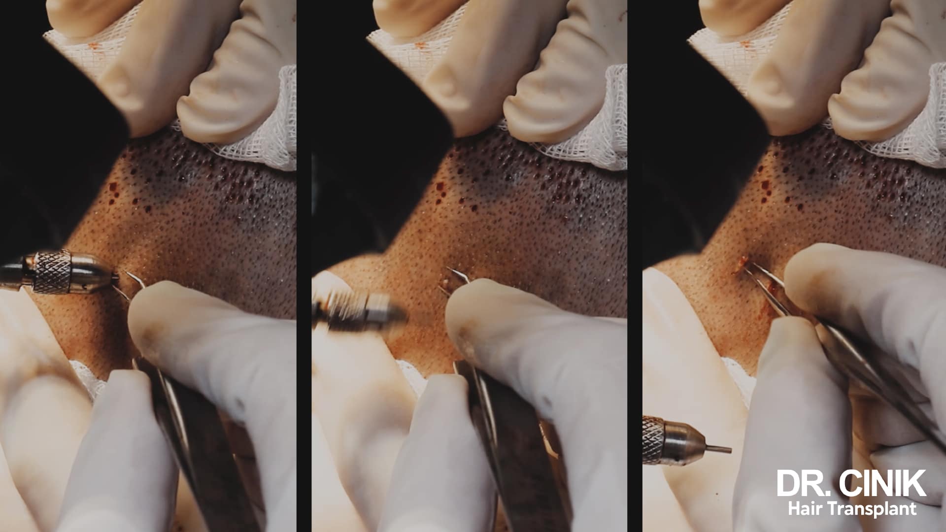 Close-up of the harvest: a hand-held punch and forceps lifting grafts from the shaved donor area