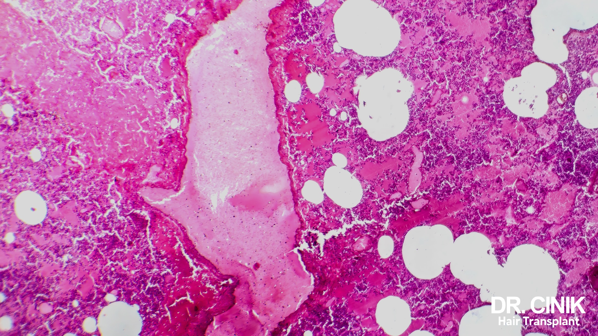 Microscope view of tissue stained pink and purple, showing pale gaps between the cells where fluid has collected