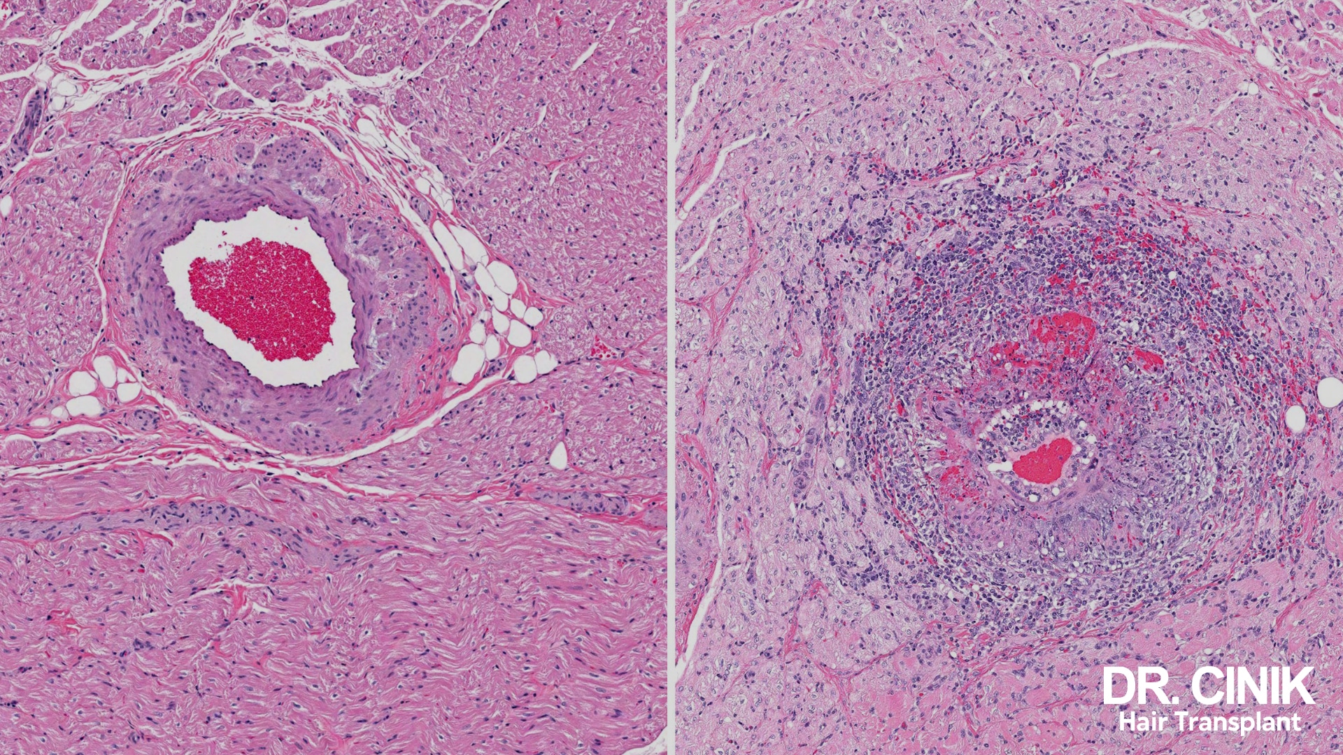 Two pink-stained histology slides: on the left a blood vessel whose lumen is packed with red blood cells, on the right a cluster of inflammatory cells around a small vessel
