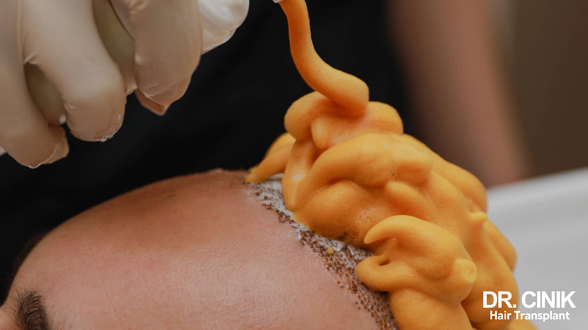 Thick post-operative foam being applied to the implanted frontal hairline from a pump bottle