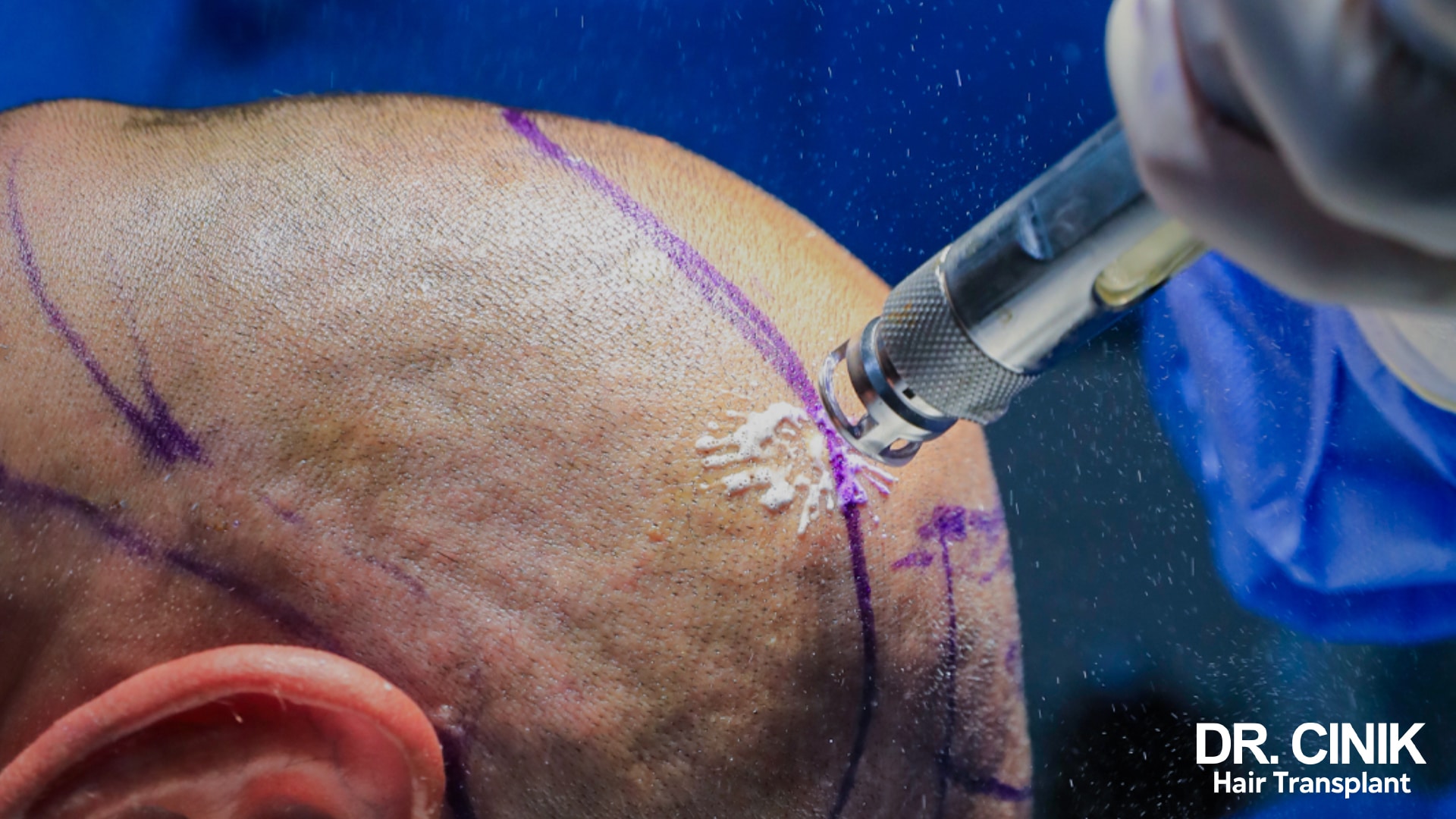 FUE micro punch harvesting a graft at the edge of the shaved donor band, outlined in purple marker