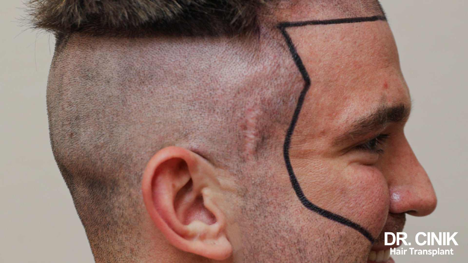 Profile of a patient with a shaved head, showing the occipital crown of hair and a felt-tip line marking the upper harvesting limit above the ear