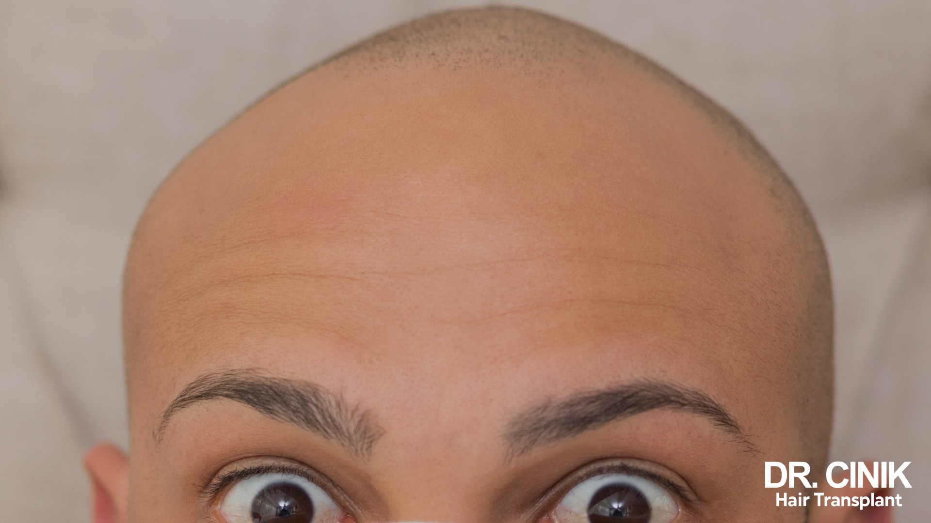 Close-up of a man's forehead and eyes after the procedure, the skin of the forehead slightly pink along the implanted hairline