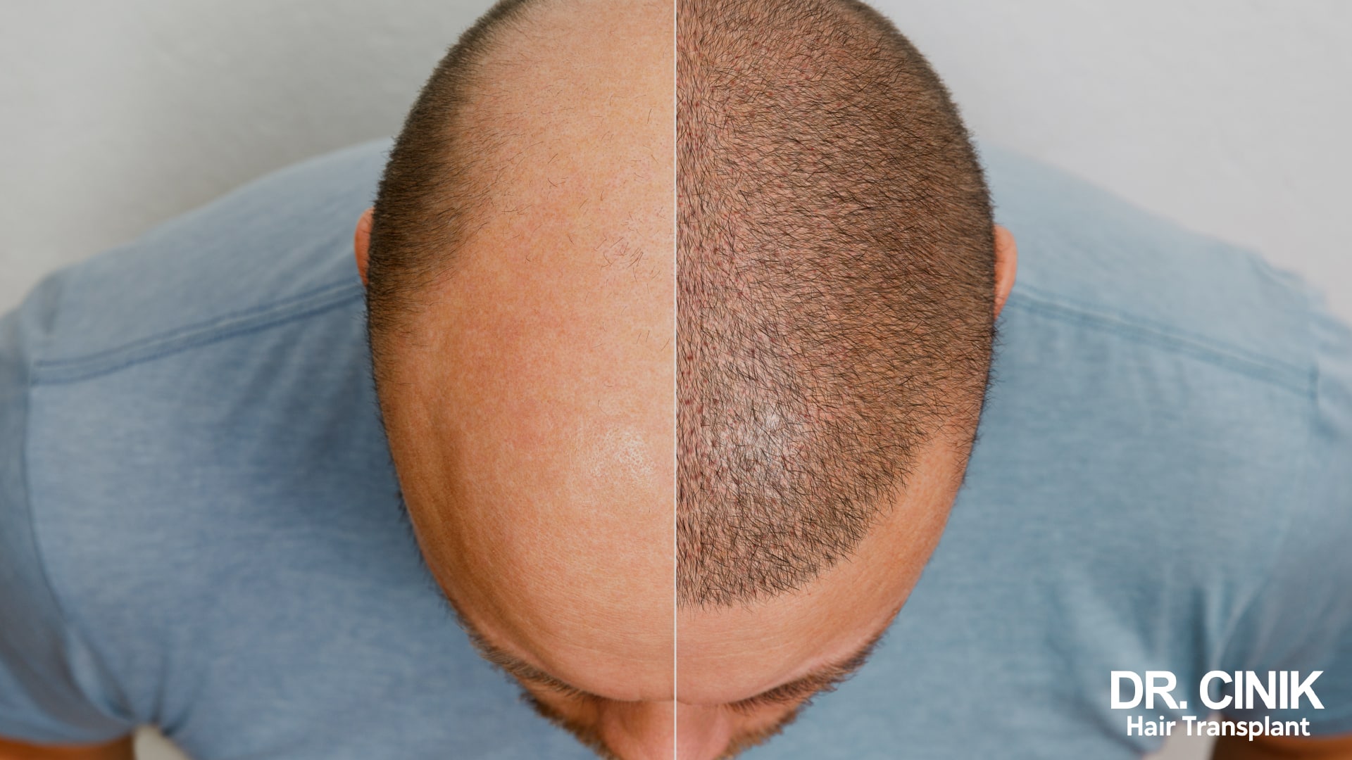 Top of the head split into two halves: on the left a thinning area, on the right the same area covered in short hair after implantation
