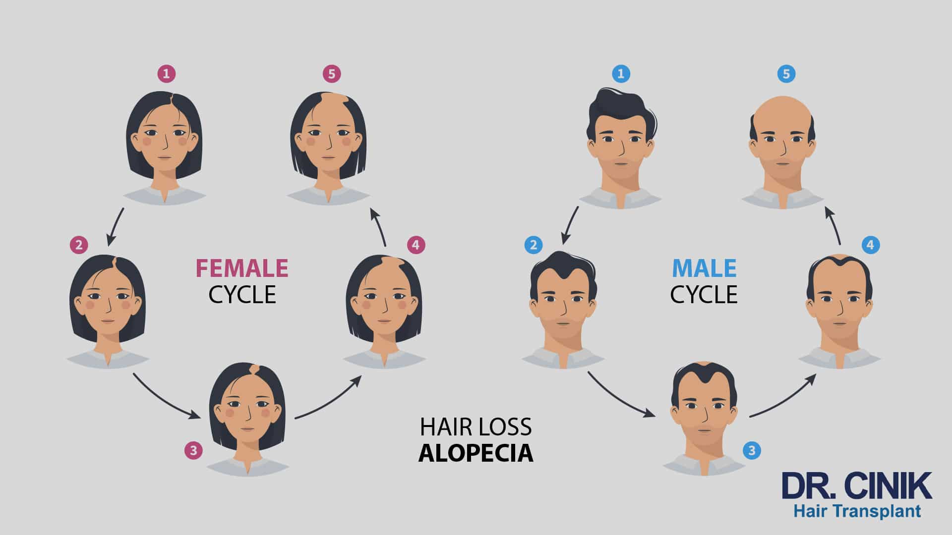 Infographic showing side by side the five stages of hair loss in a woman and in a man, from a full head of hair to established baldness, captioned female cycle, male cycle and hair loss alopecia