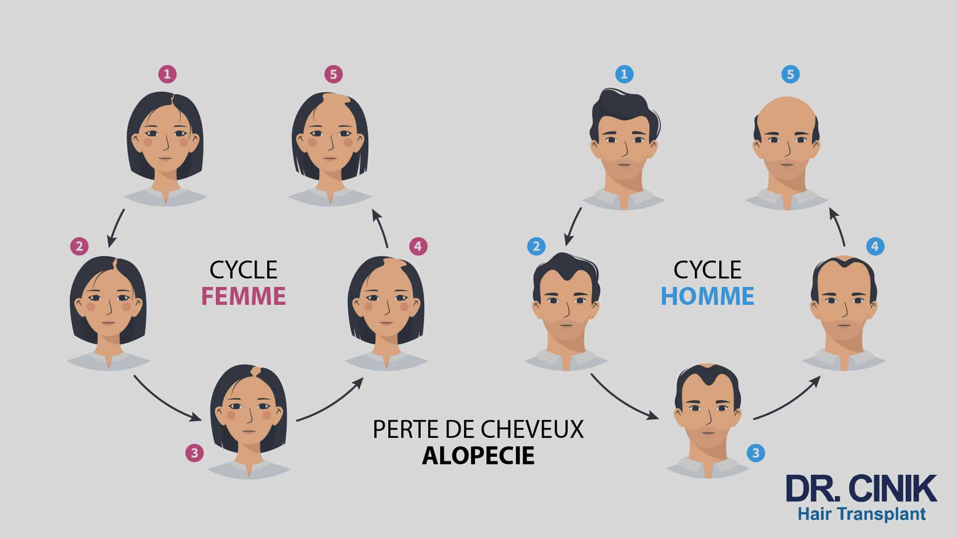 Infographie montrant côte à côte l'évolution de la perte de cheveux en cinq étapes chez une femme et chez un homme, du cuir chevelu fourni à la calvitie installée