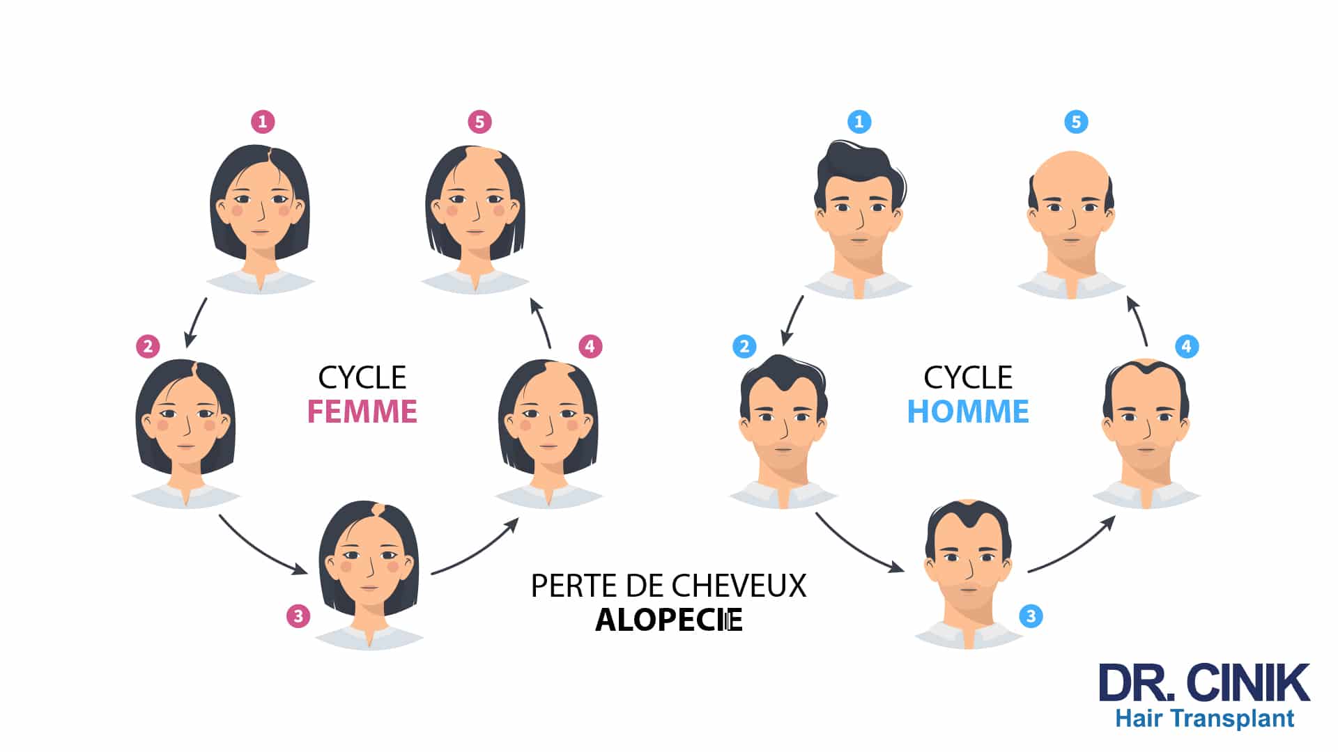 Infographie Dr Cinik comparant le cycle femme et le cycle homme de la perte de cheveux en cinq étapes, du cuir chevelu garni à la calvitie installée