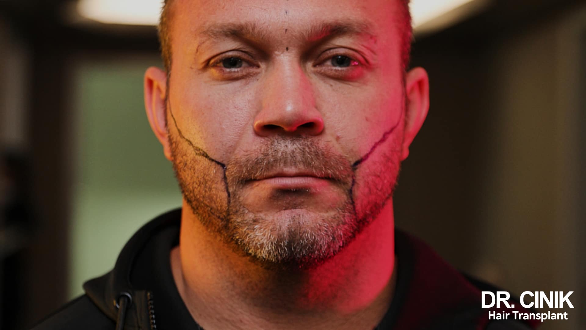 Portrait d'un homme dont le contour de barbe a été tracé au crayon chirurgical avant l'intervention, sous un éclairage rouge et vert