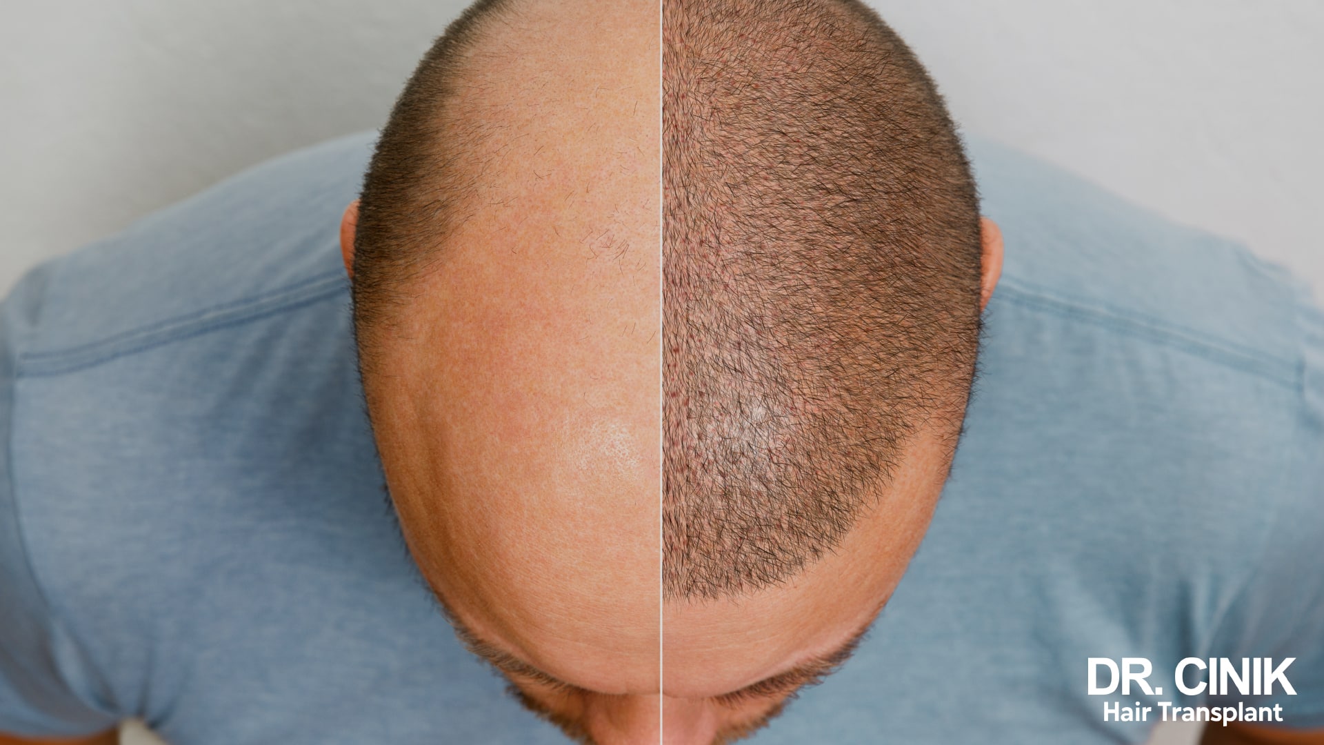 Split top-down view of one head: a bare, thinning crown on the left half, short dense regrowth on the right half