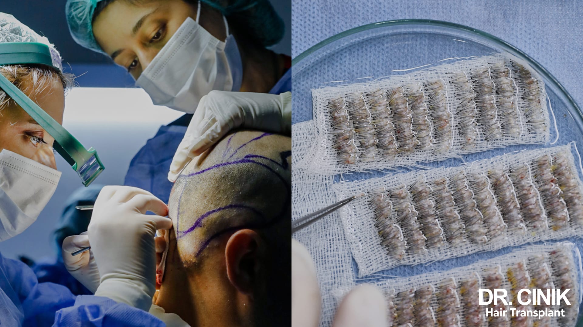 Split view of a surgical team wearing loupes working on a shaved scalp marked with violet ink, next to a Petri dish where grafts are lined up in tight rows on gauze