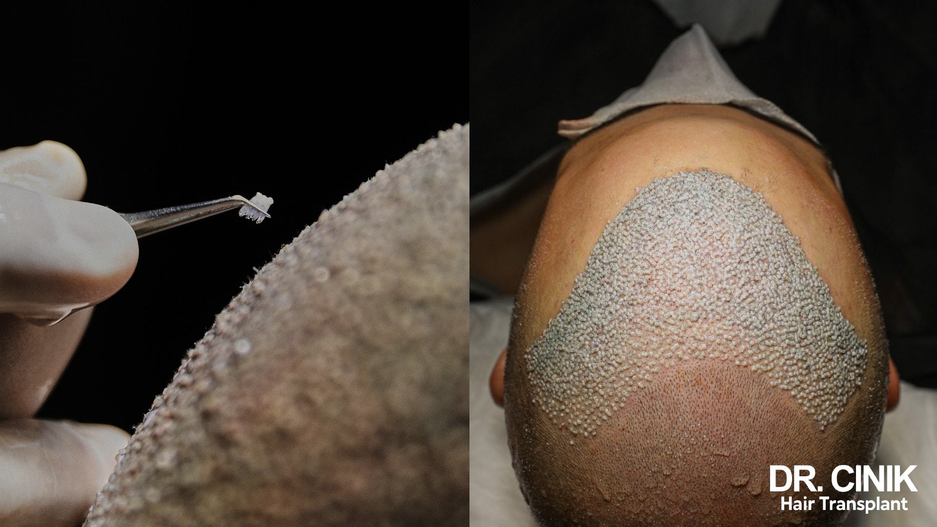 A single graft held in forceps above the scalp, and a top-down view of a recipient area fully implanted at the end of the session
