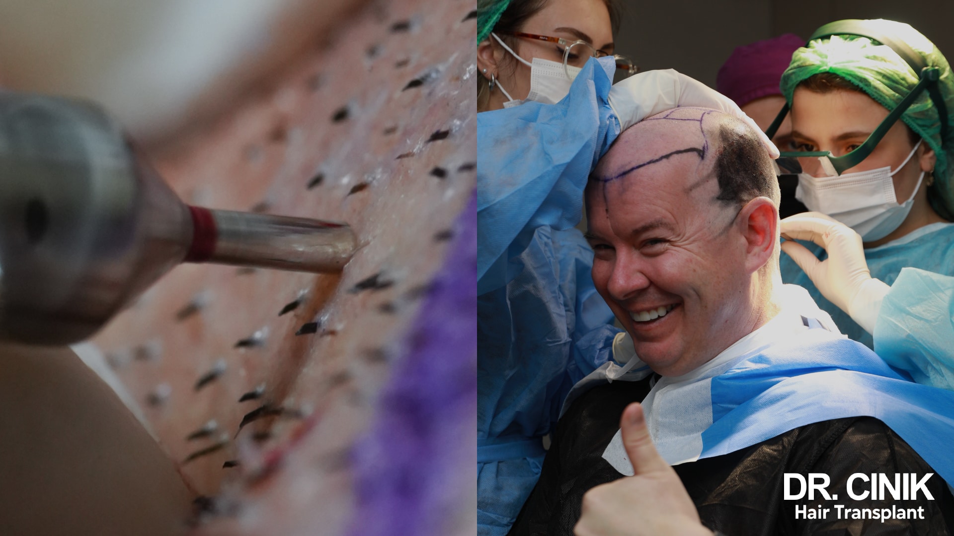 Close-up of hair grafts inserted into the scalp and held with surgical forceps, next to a patient with a shaved head surrounded by the medical team
