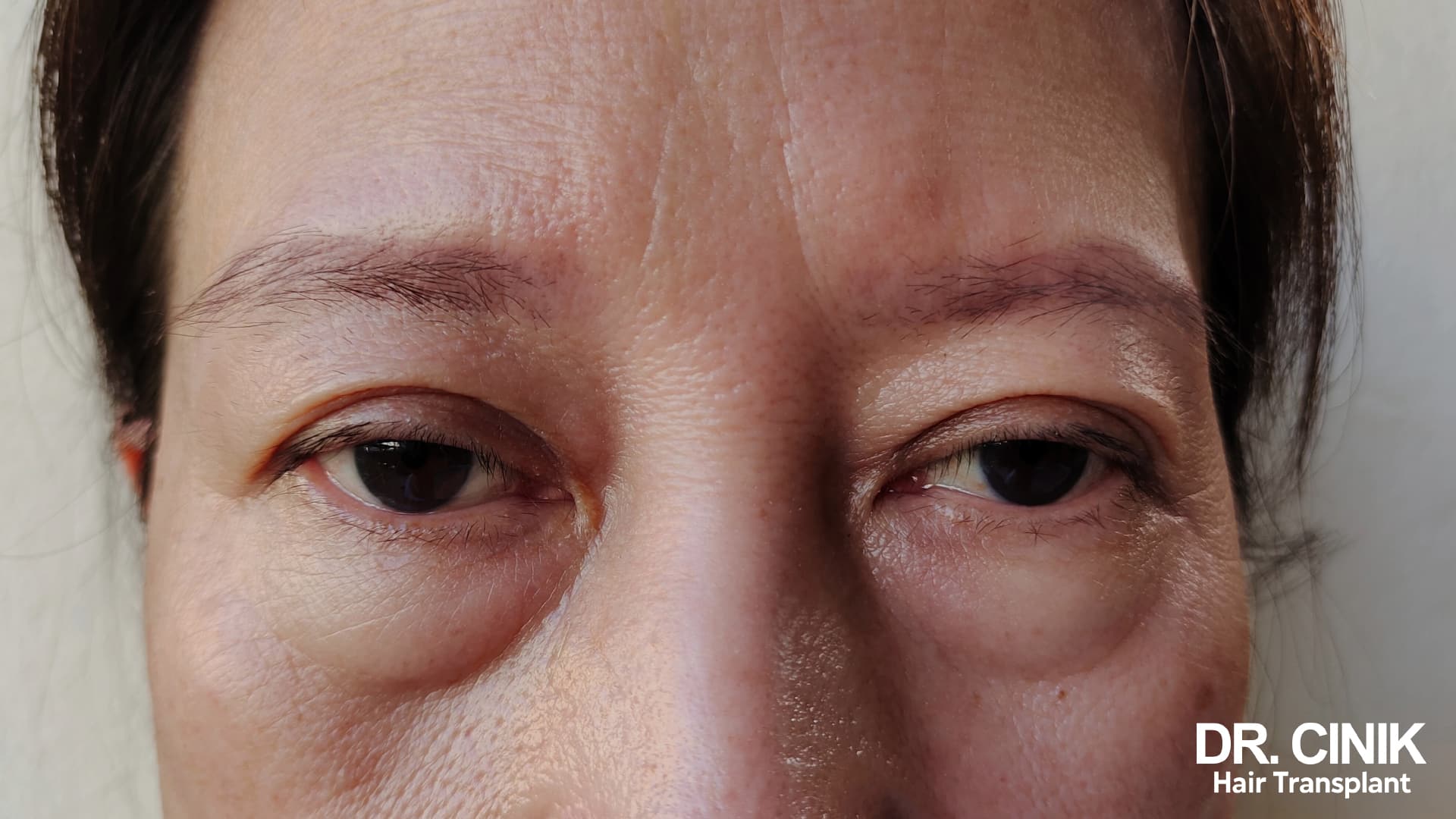 Close-up of the upper face of a female patient, upper and lower eyelids slightly puffy, gaze a little heavy