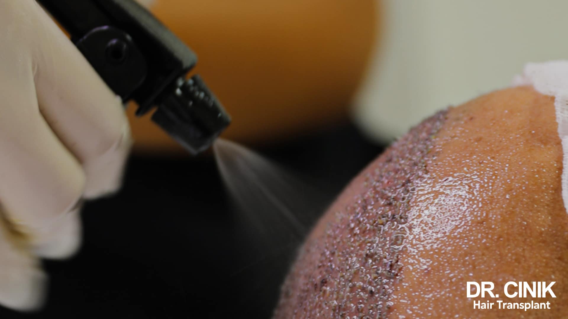 A fine saline mist being sprayed onto a recipient area still covered with thin scabs