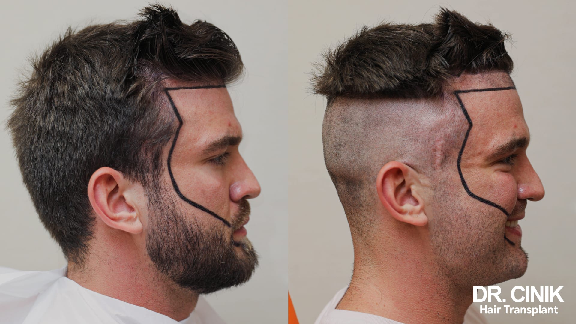 Side view before and after shaving the sides of the scalp, with the frontal edge and the lateral donor band drawn in black marker