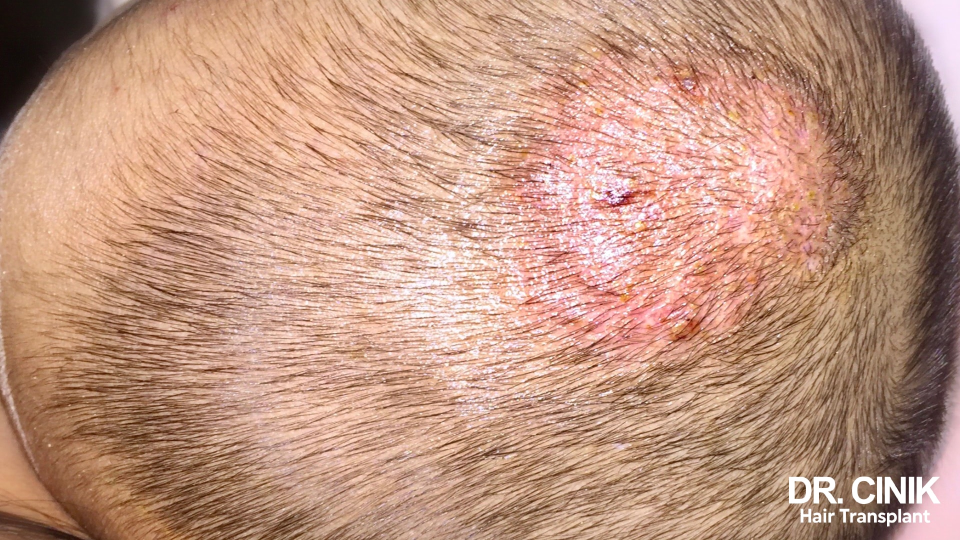 Inflamed patch of scalp scattered with yellowish pustules and fine crusting, typical of folliculitis
