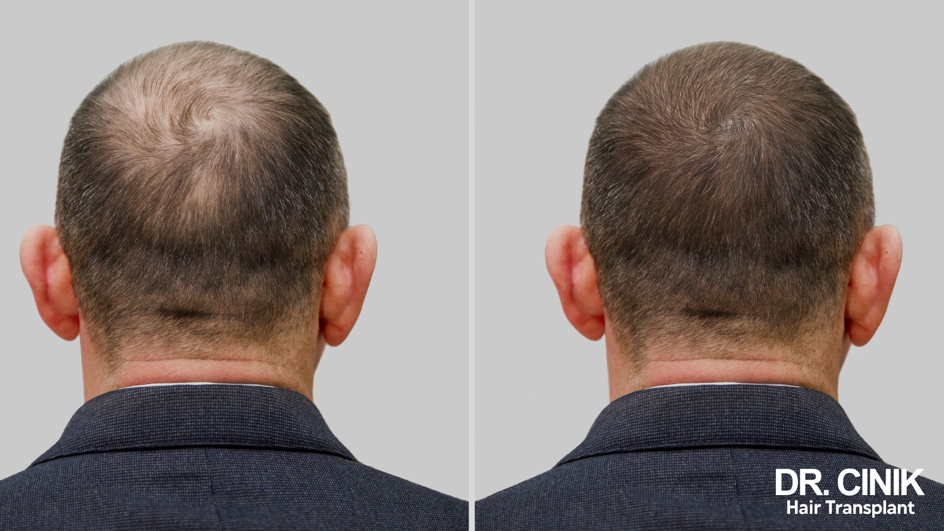 Two rear views of the same short-cropped head, the vertex sparse on one side and visibly fuller on the other