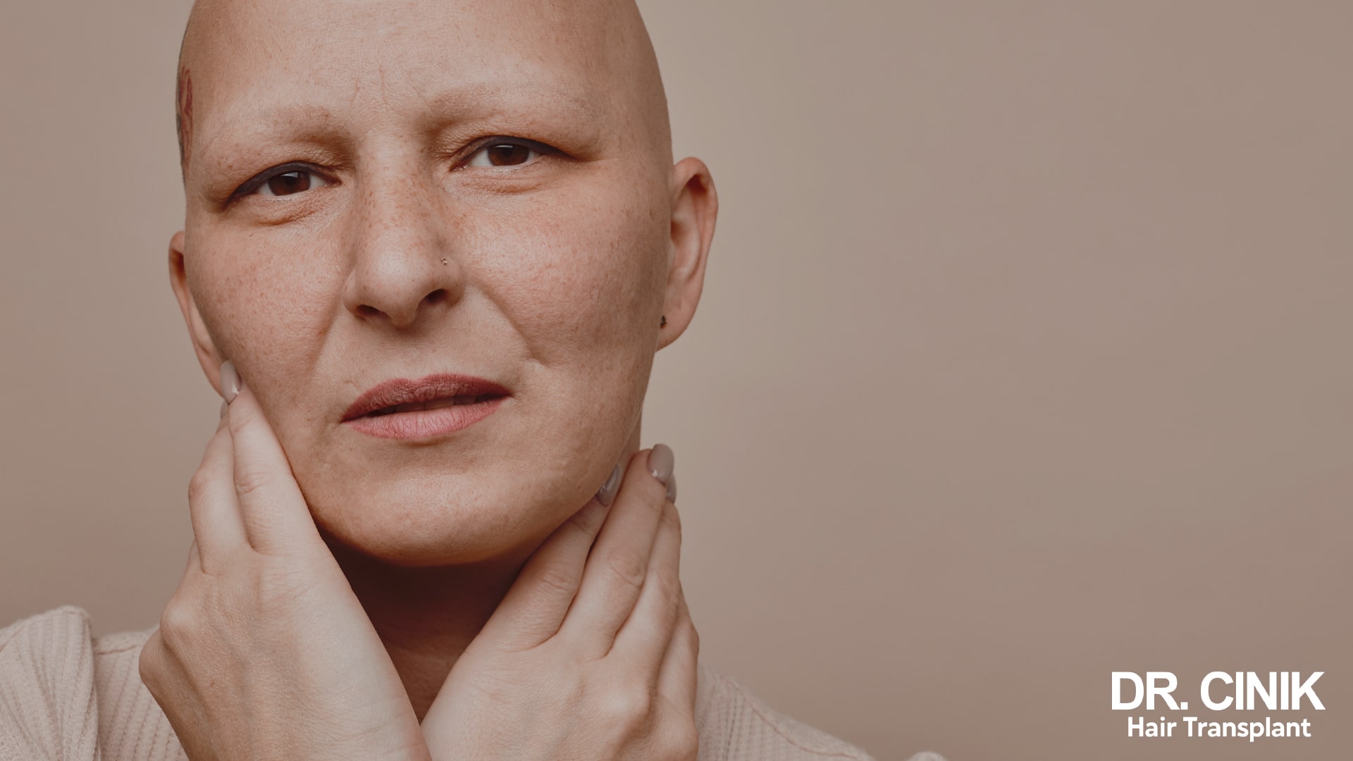 Woman with a fully bald scalp, hands resting on her face and neck, against a beige background