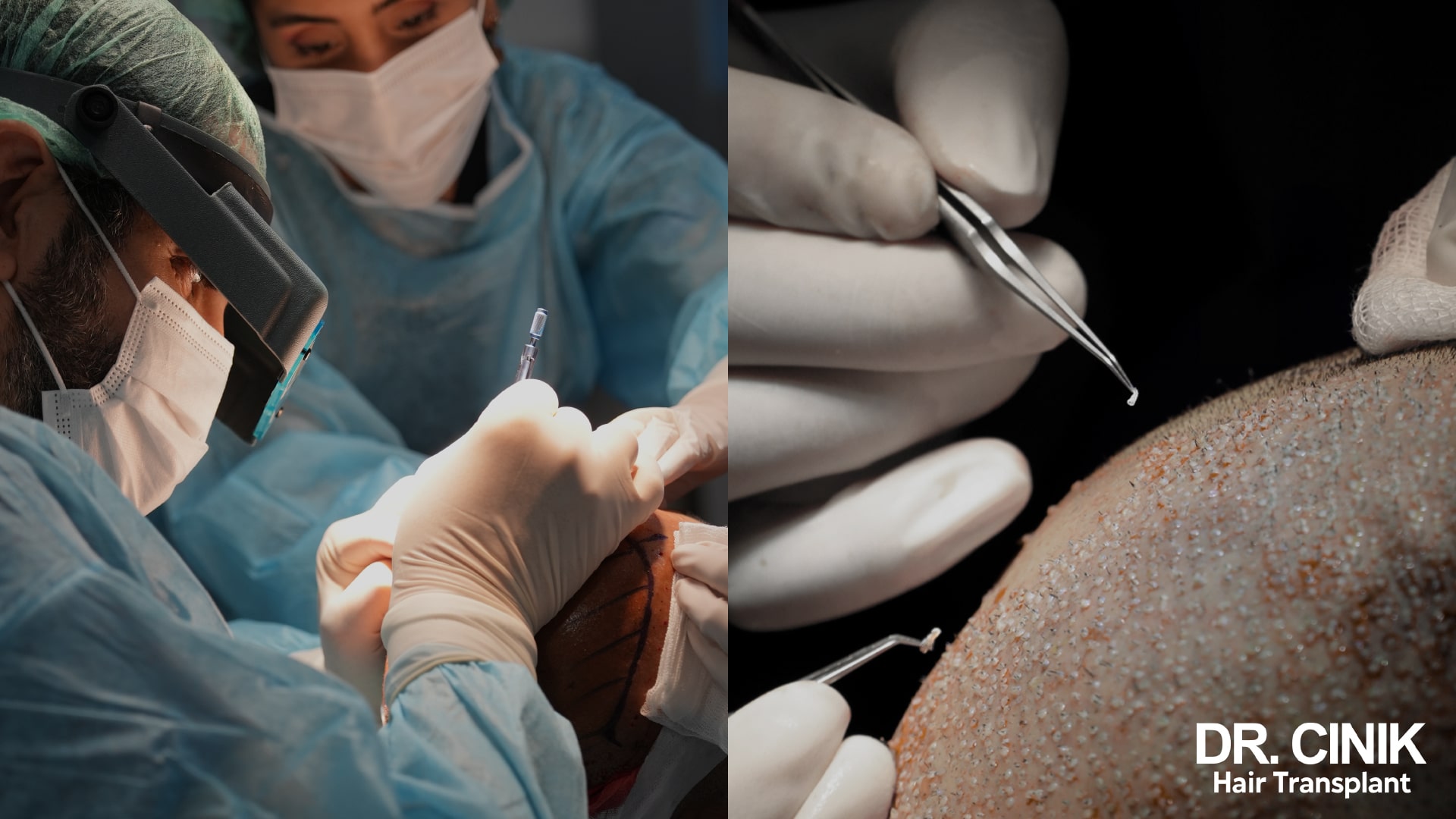 Split view of a surgeon wearing a headband loupe working on a scalp marked with ink, next to fine forceps placing a graft on an already densely implanted recipient area