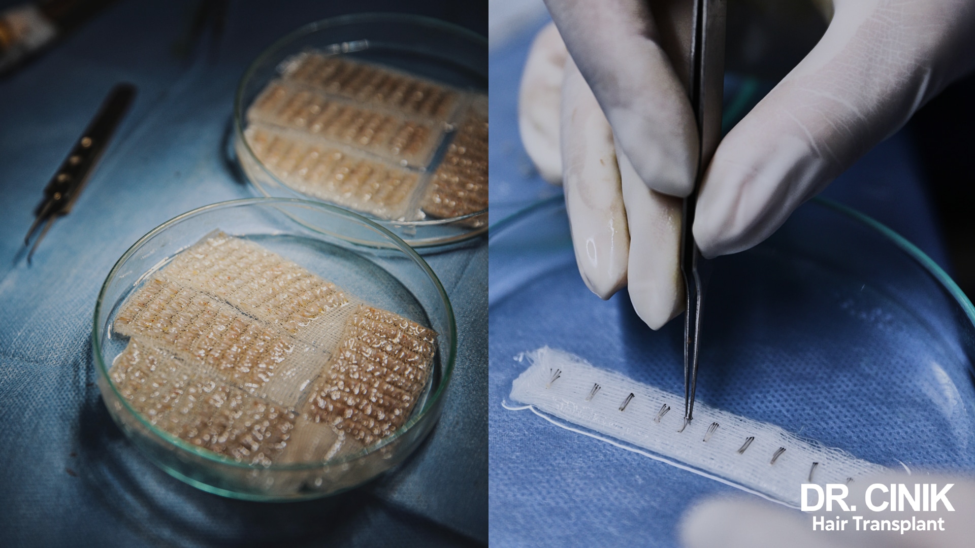 Harvested grafts kept in Petri dishes on damp gauze, then lined up and counted with forceps before implantation