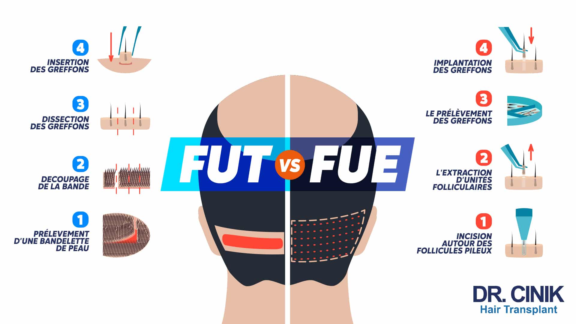 Infographie comparant en quatre étapes numérotées la technique FUT, avec prélèvement d'une bandelette de peau puis dissection des greffons, et la technique FUE, avec incision autour des follicules puis extraction et implantation