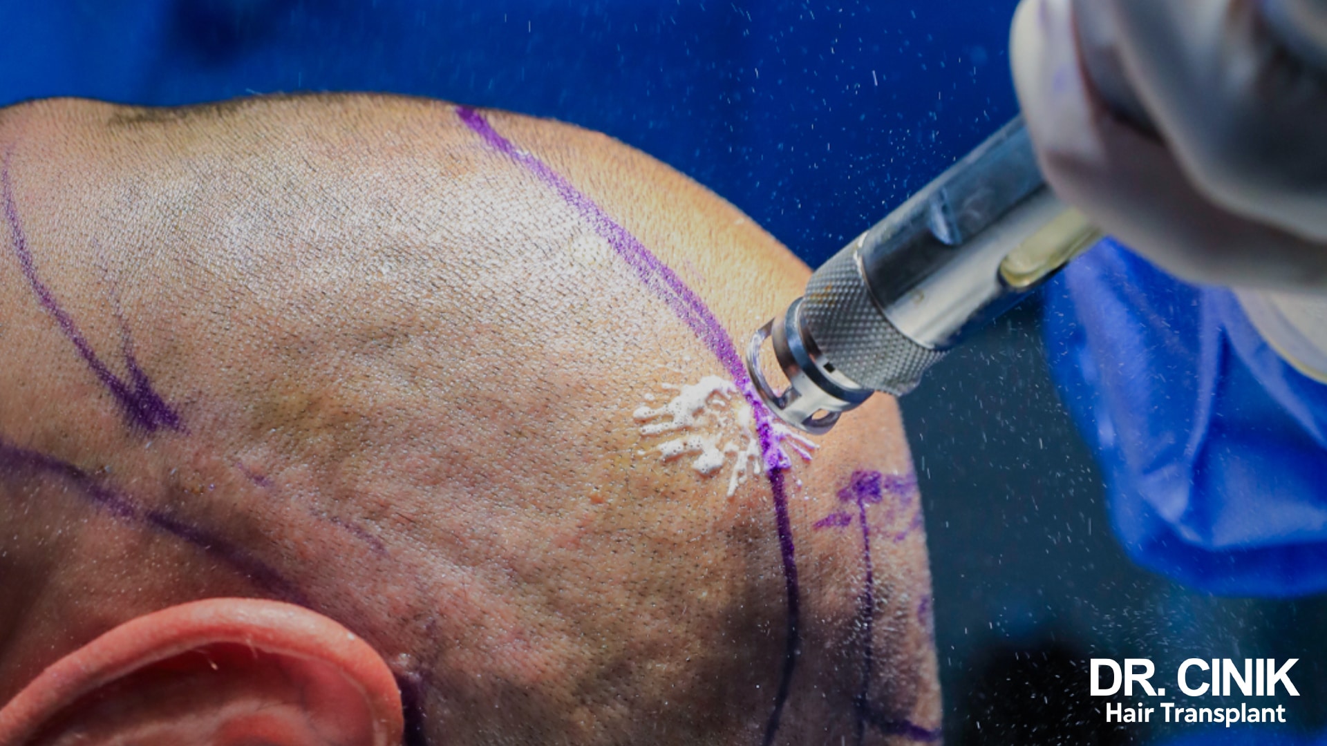Metal needle-free injector pressed against a scalp marked out in purple pen during surgery, droplets suspended in the air