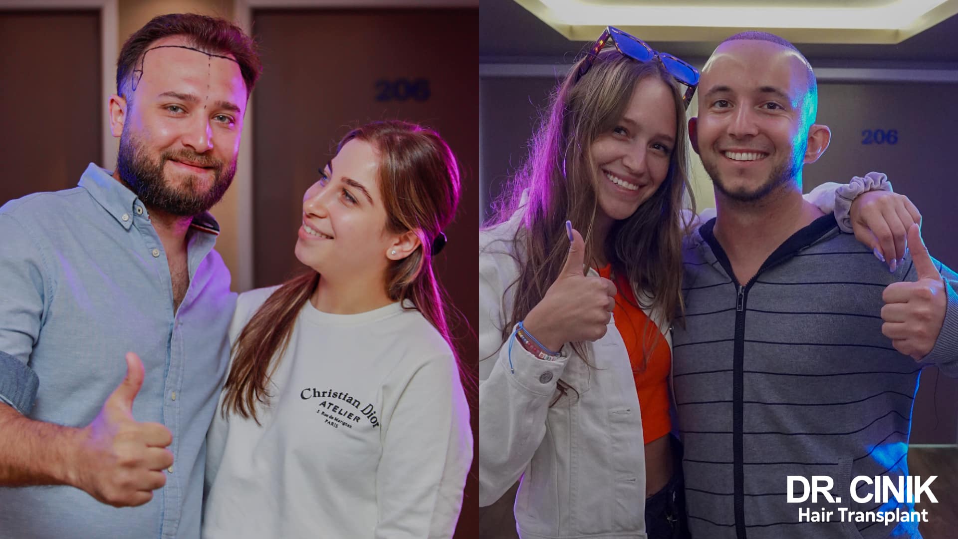 Two couples of patients giving a thumbs up in a clinic corridor, the outline of the future hairline still visible in marker pen on the scalp of one of them