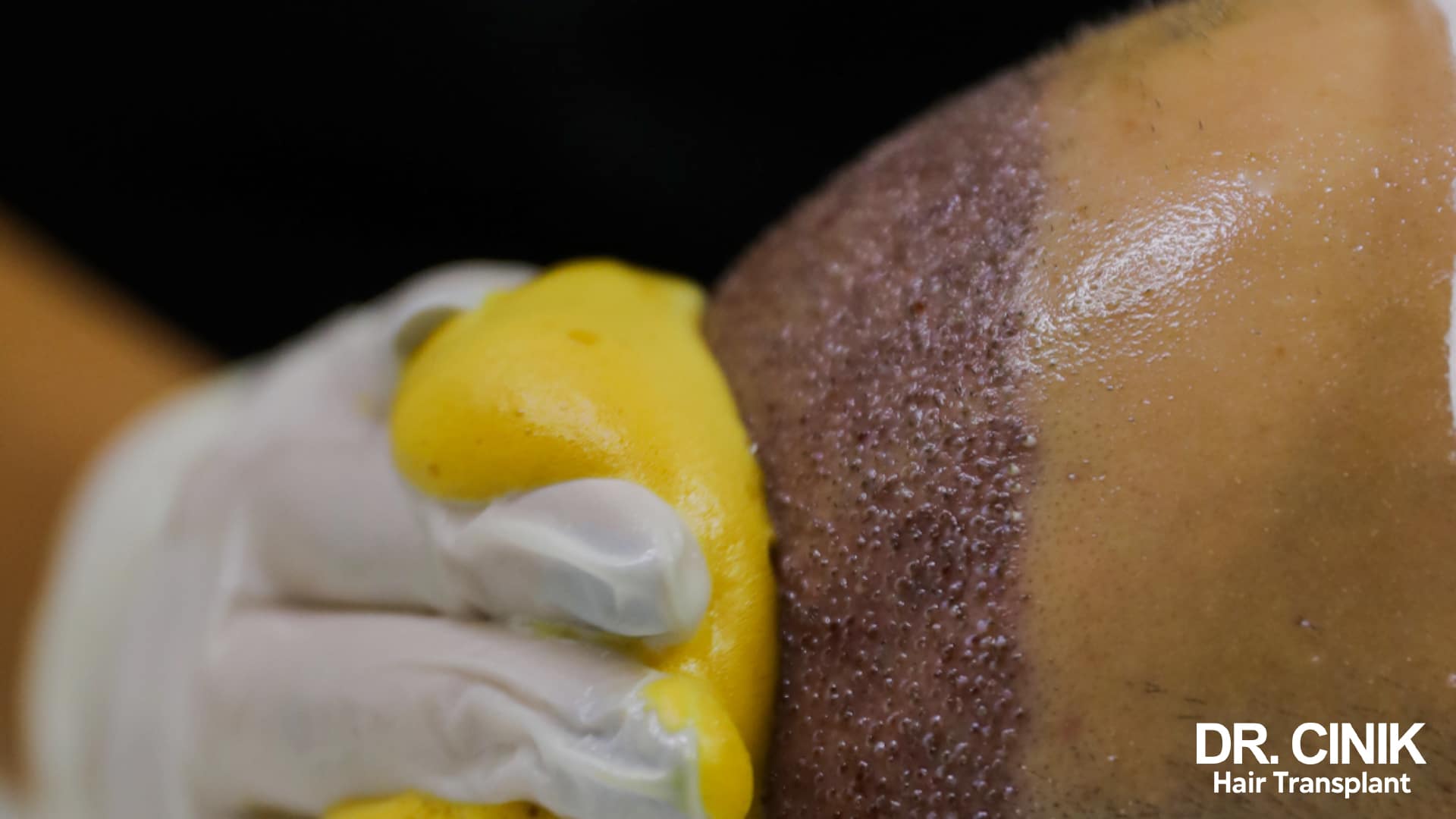 A yellow foam being massaged into a scalp covered in scabs, during the loosening phase