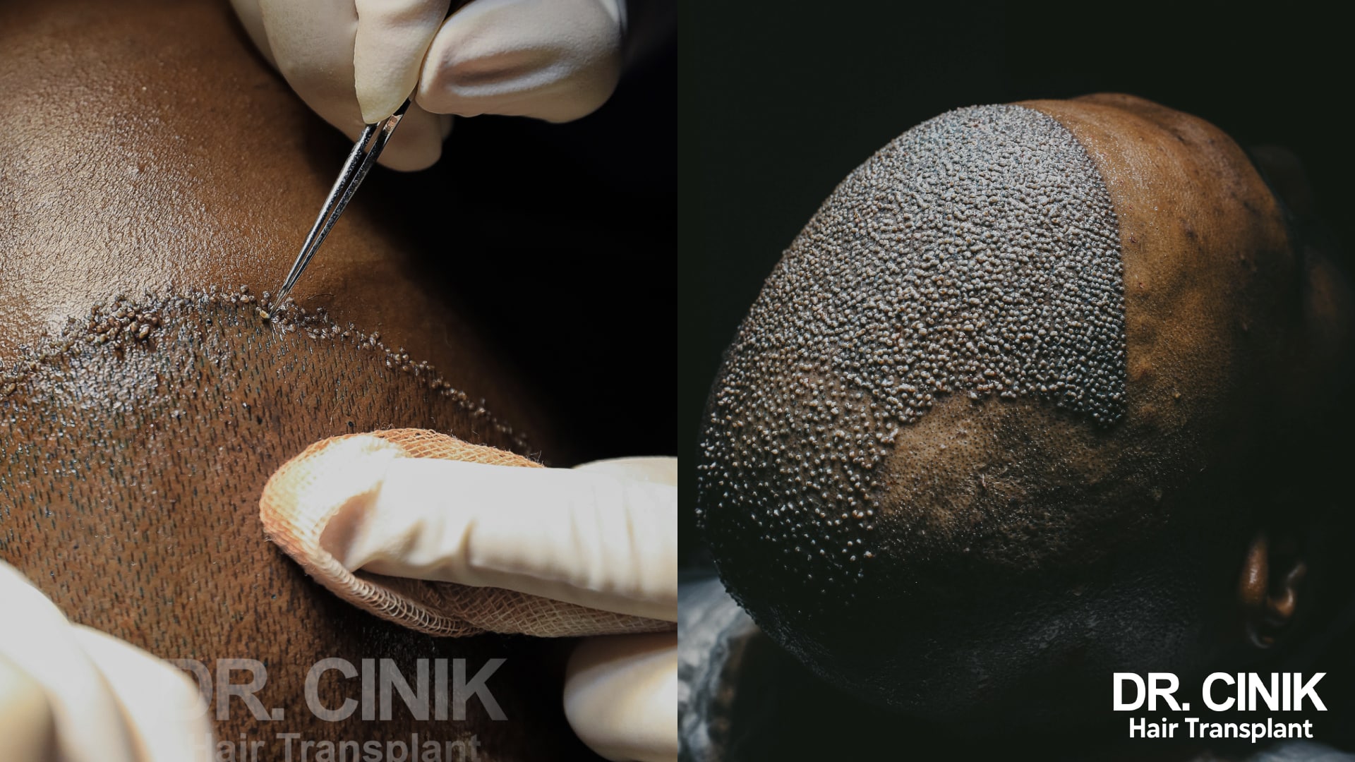 Forceps placing grafts one by one along the frontal edge, and a top view of the scalp fully covered with grafts at the end of the session