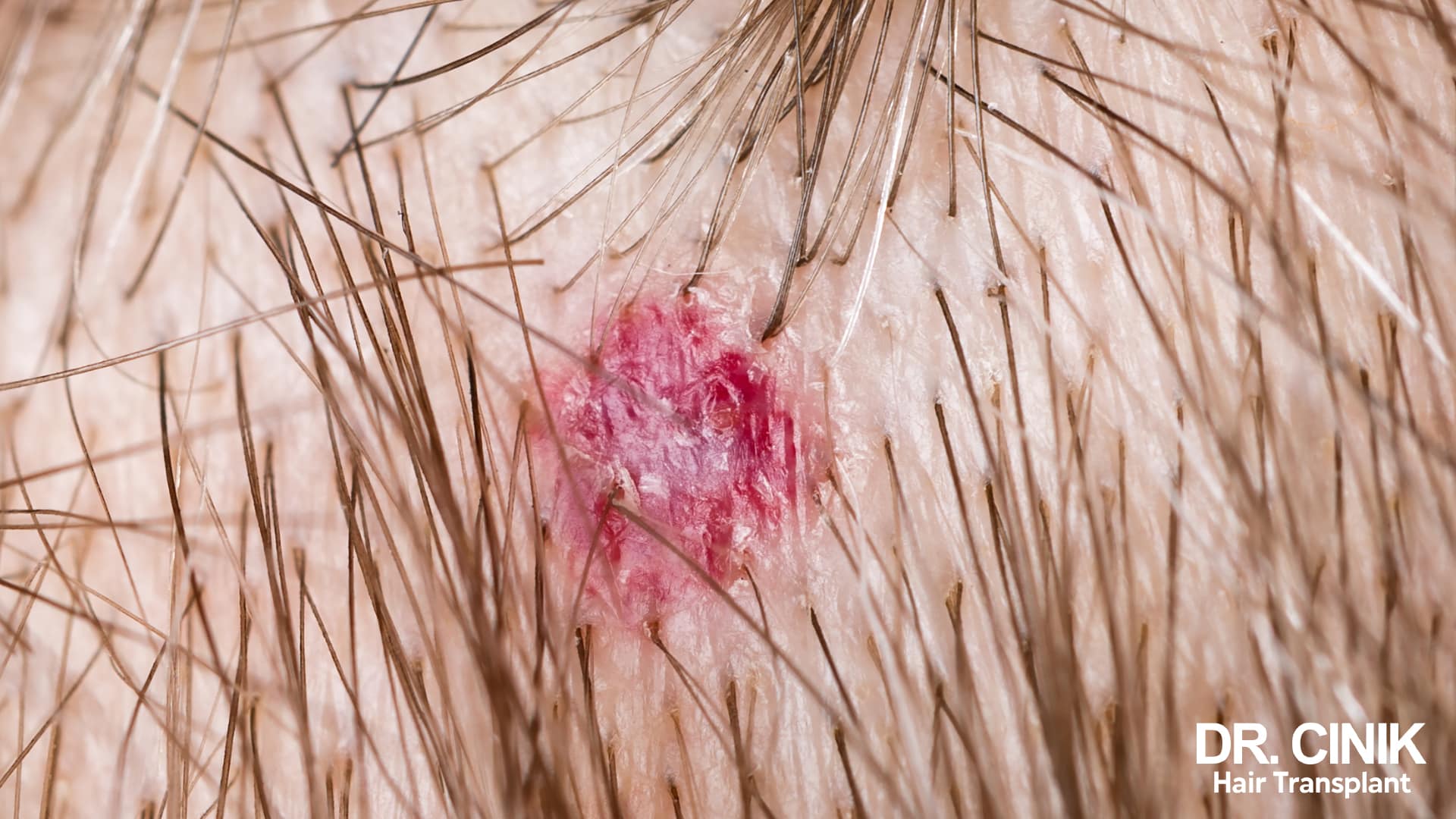 Isolated inflammatory lesion, bright red and slightly weeping, in the middle of the scalp, seen in close-up