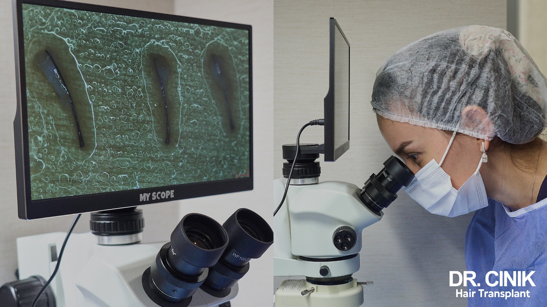 Grafts under a stereomicroscope: three magnified follicular units with intact bulbs on the screen, and an assistant at the eyepieces