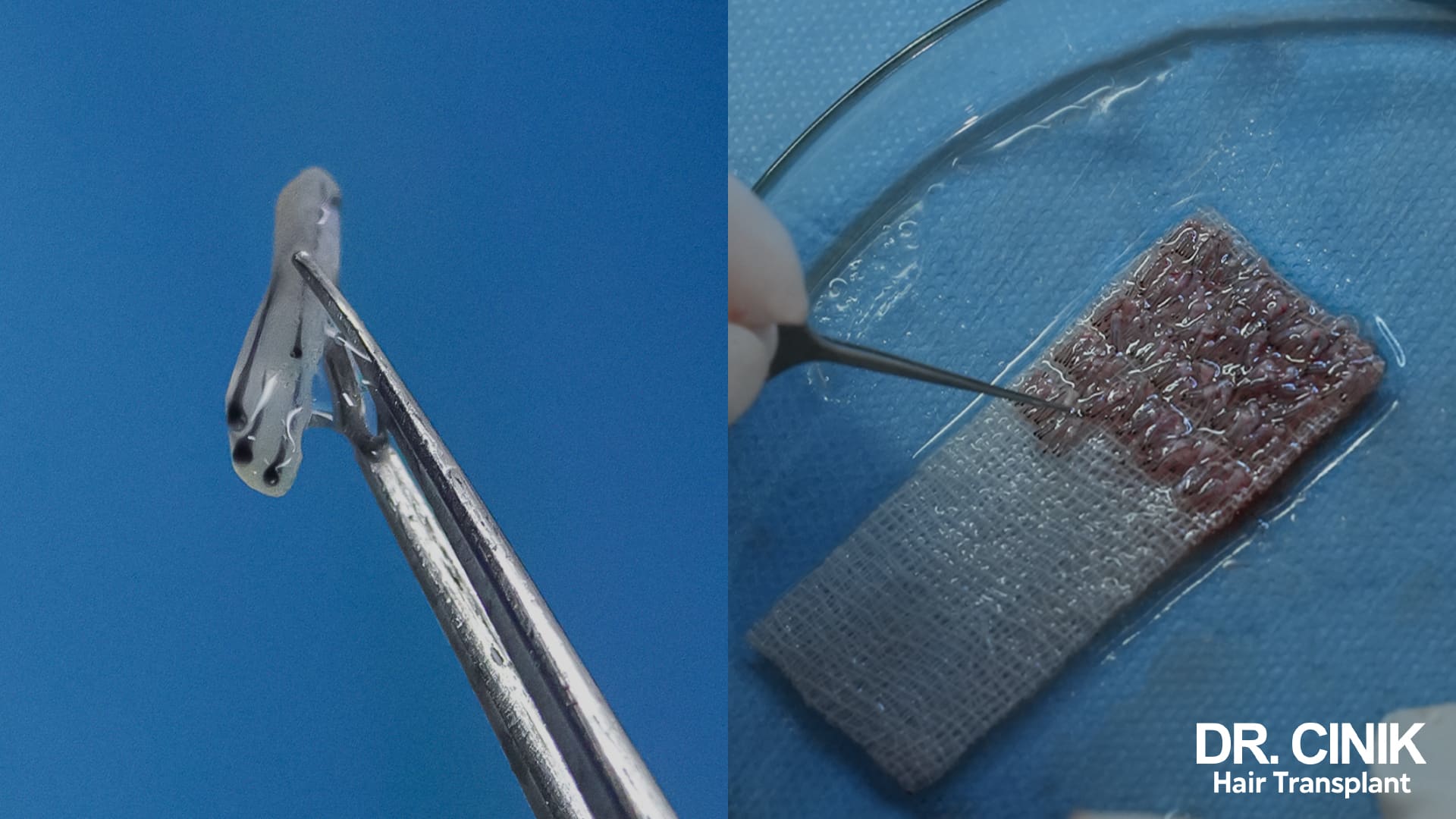 Close-up of a hair graft held in fine forceps against a blue background, next to a strip of graft-rich skin being handled in a tray