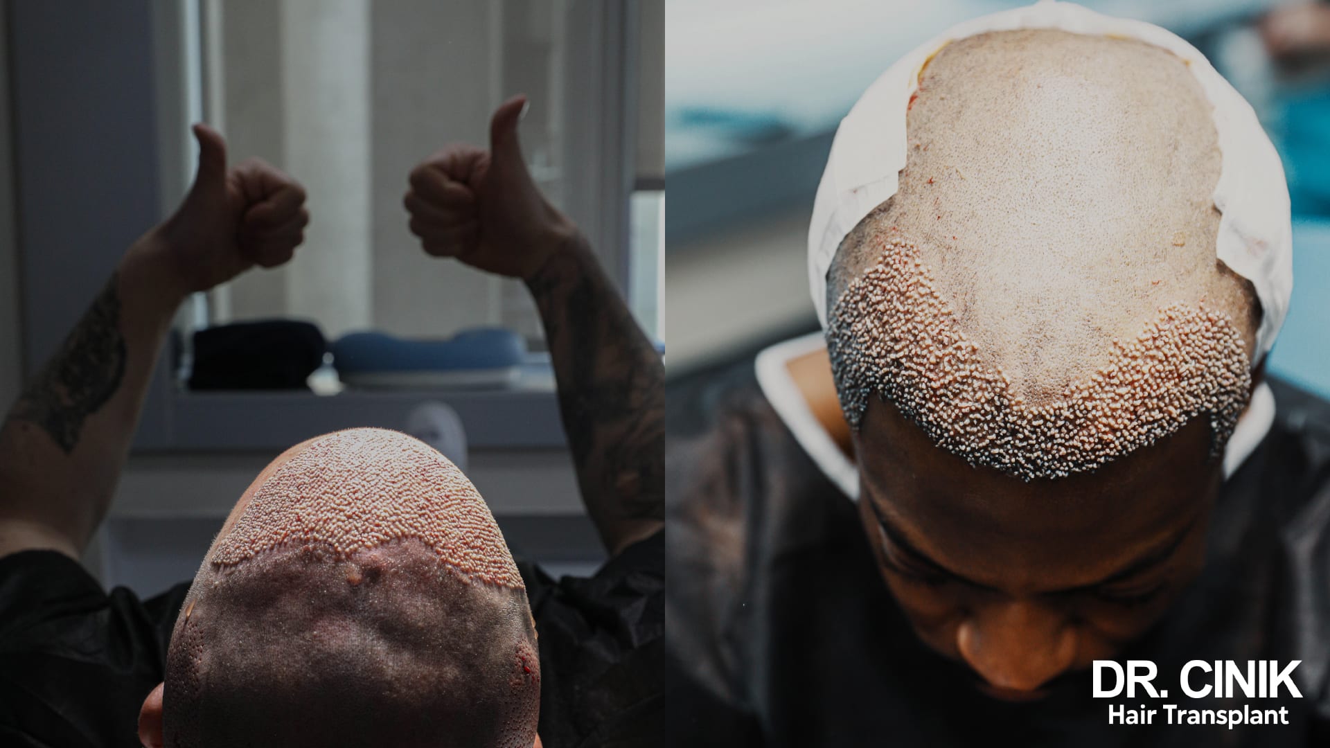 Two views of a patient immediately after surgery, grafts implanted in tight rows across the recipient area, thumbs up