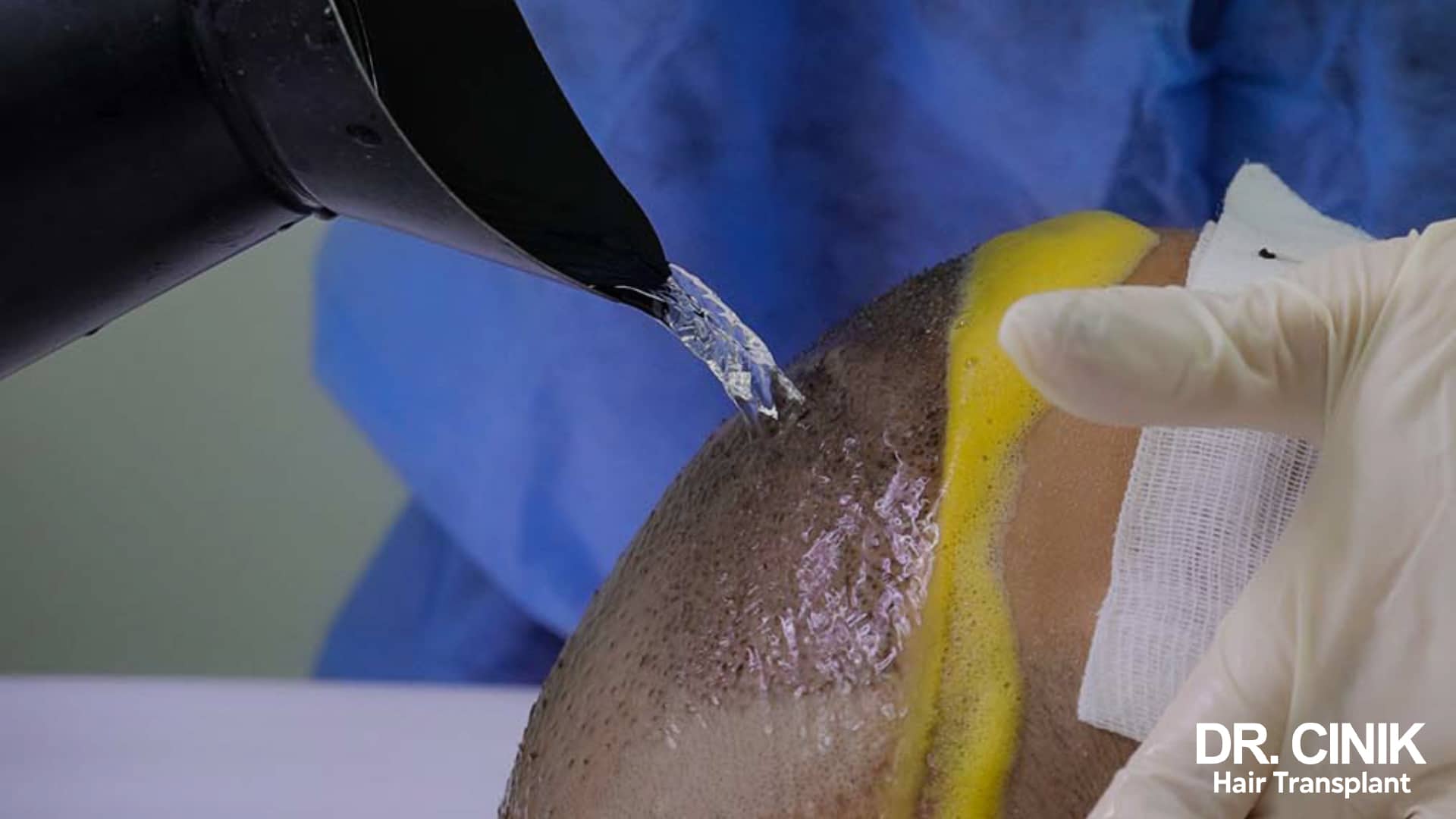 Lukewarm water being poured from a jug over the scalp, the grafted area shielded by a compress