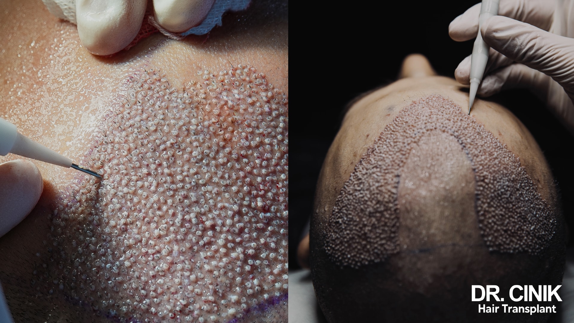 Close-up of graft implantation density along the frontal line, and pen implantation across the crown outlined in marker