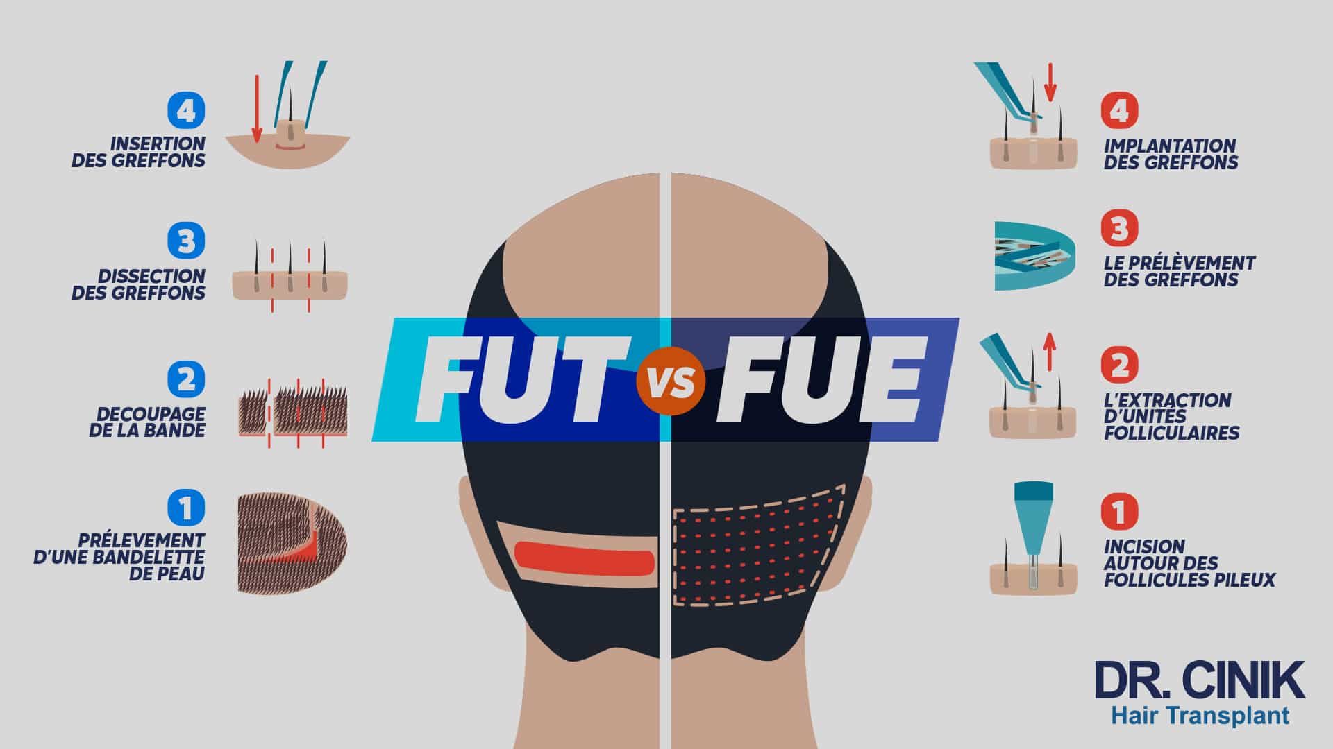 Infographie opposant les quatre étapes de la FUT, du prélèvement de la bandelette de peau à l'insertion des greffons, aux quatre étapes de la FUE, de l'incision autour du follicule à l'implantation