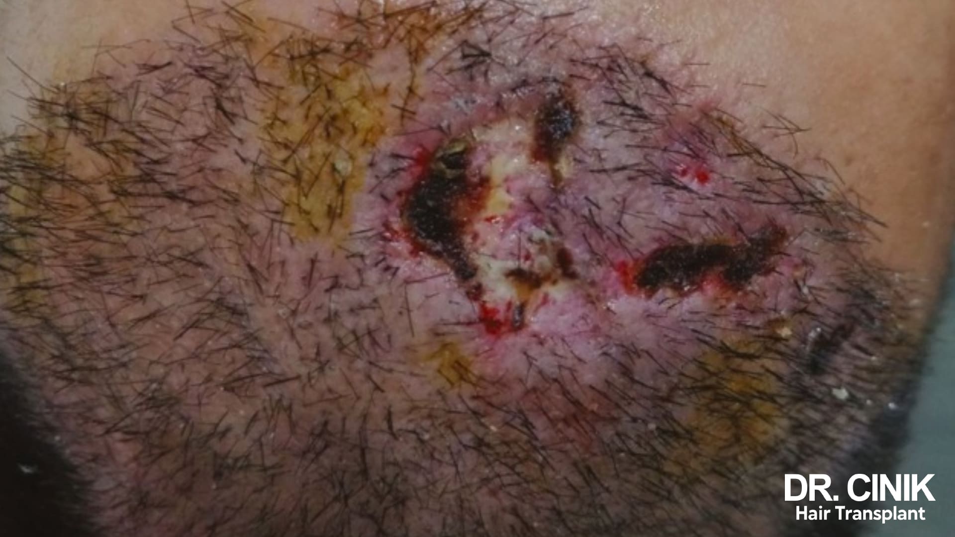 Patch of scalp with a blackish crusted wound and a red inflamed border, short hair all around