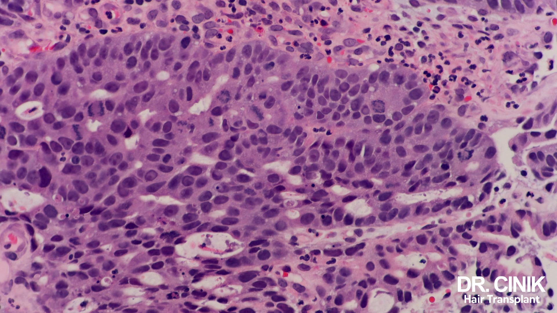 Tissue section under the microscope, cells stained purple and small vessels filled with red blood cells