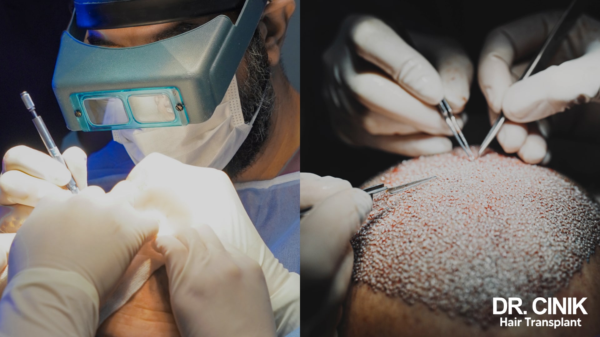 Surgeon wearing binocular loupes implanting grafts one by one into a shaved recipient area dotted with incision points
