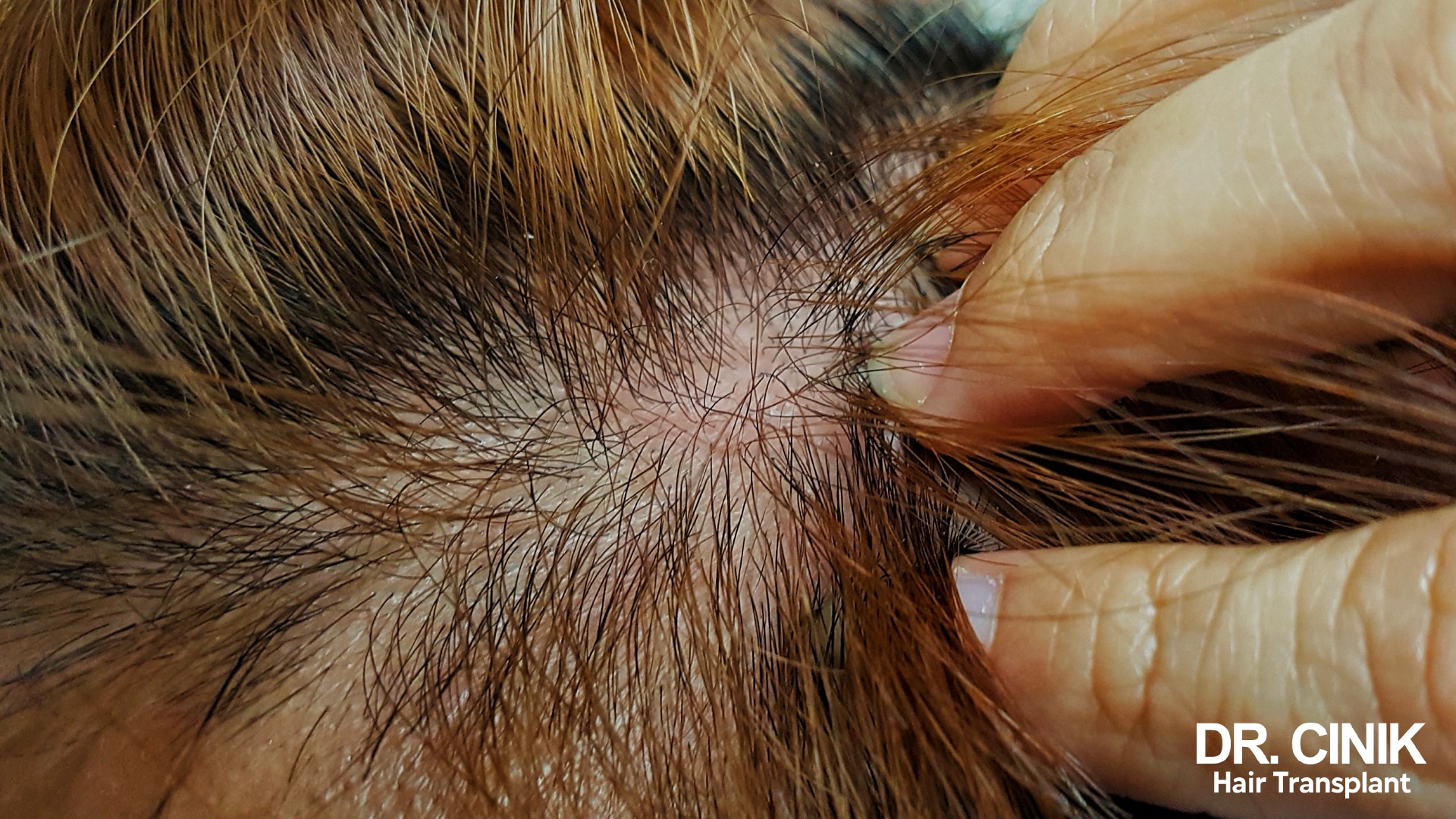 Close up of a scalp parted by hand, showing visible skin and sparse hair at the roots