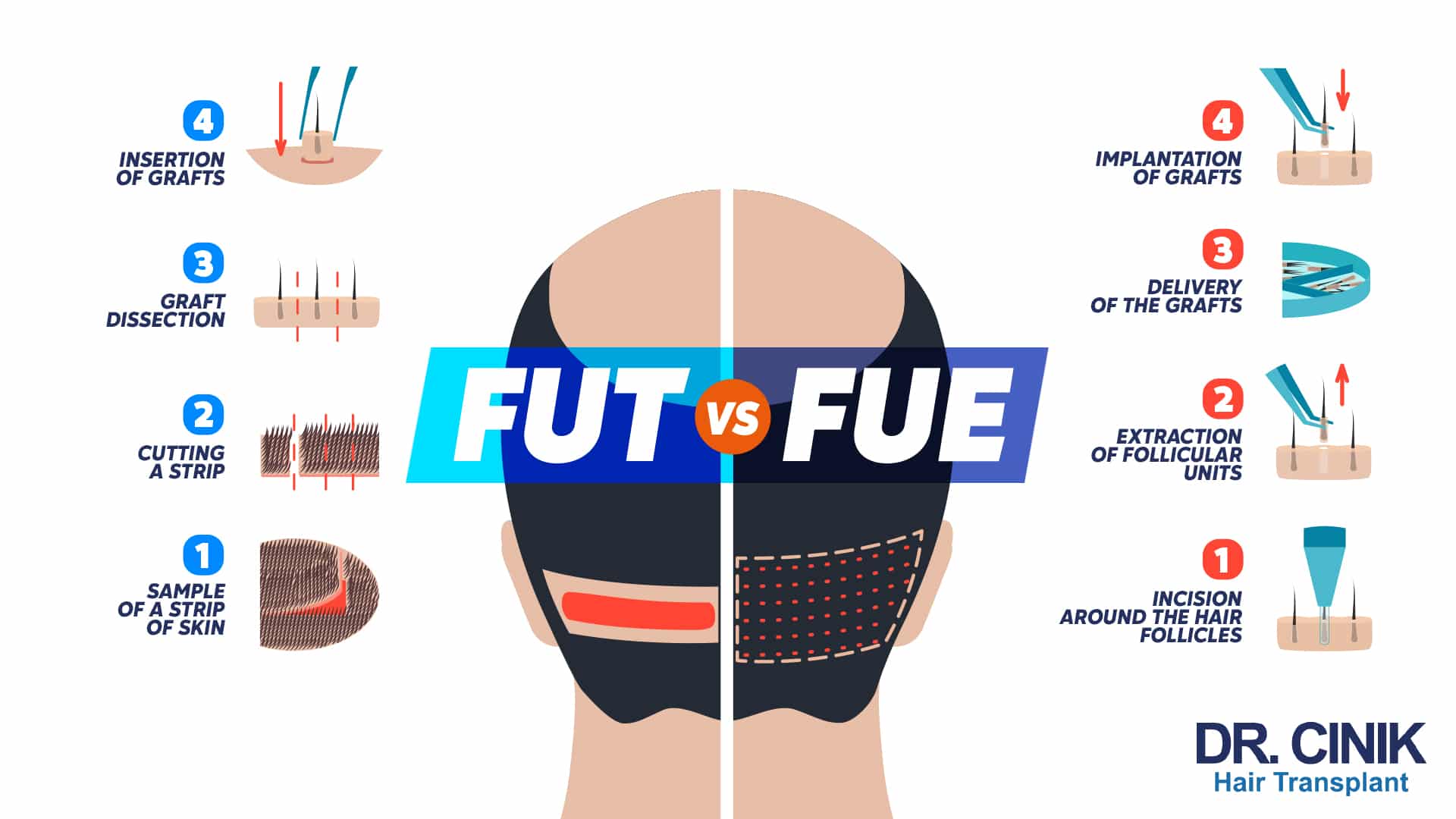 FUT versus FUE infographic: on the left, sample of a strip of skin, cutting a strip, graft dissection then insertion of grafts; on the right, incision around the hair follicles, extraction of follicular units, delivery of the grafts then implantation