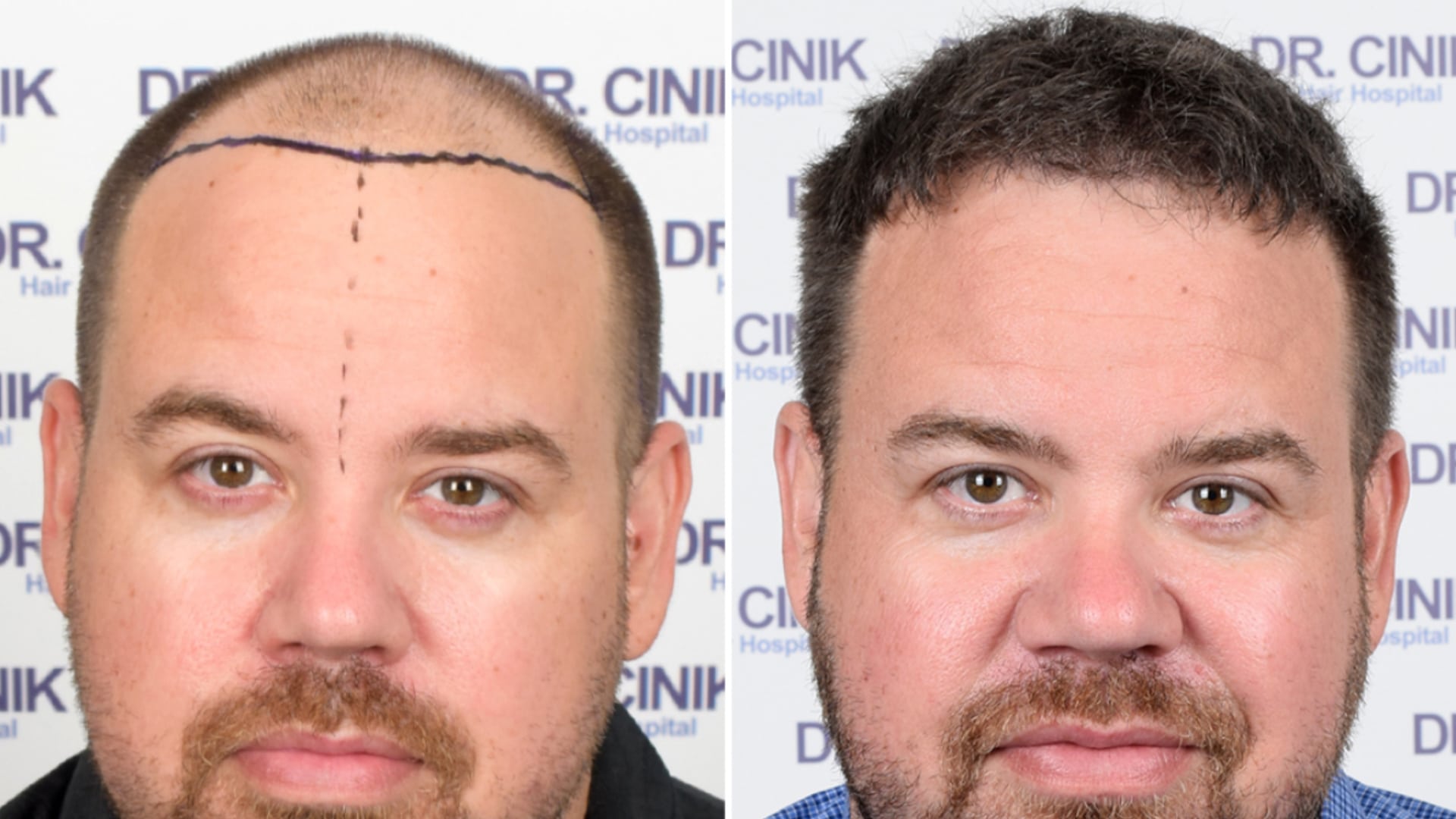 Man with receded temples and the planned frontal line drawn in marker, then the same head with dense frontal hair after the transplant