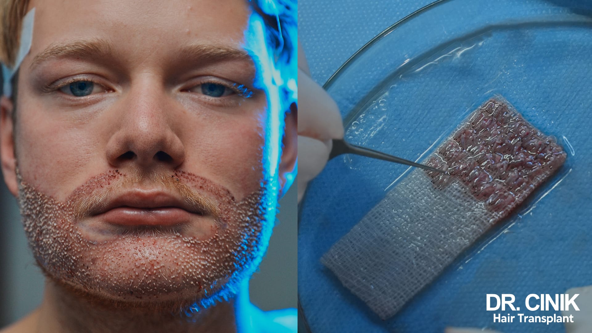 Visage d'un patient juste après une greffe de barbe, greffons implantés visibles sur les joues, à côté d'une compresse portant les unités folliculaires prélevées