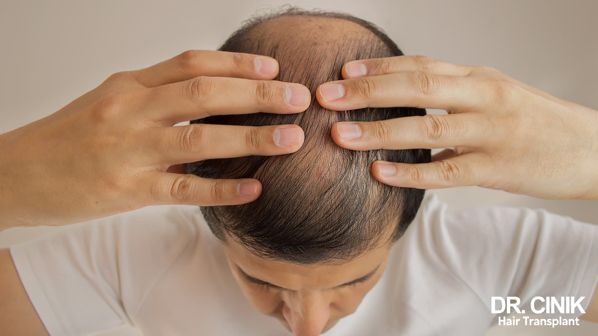 Overhead view of a man parting his hair with both hands, revealing a sparse scalp at the crown