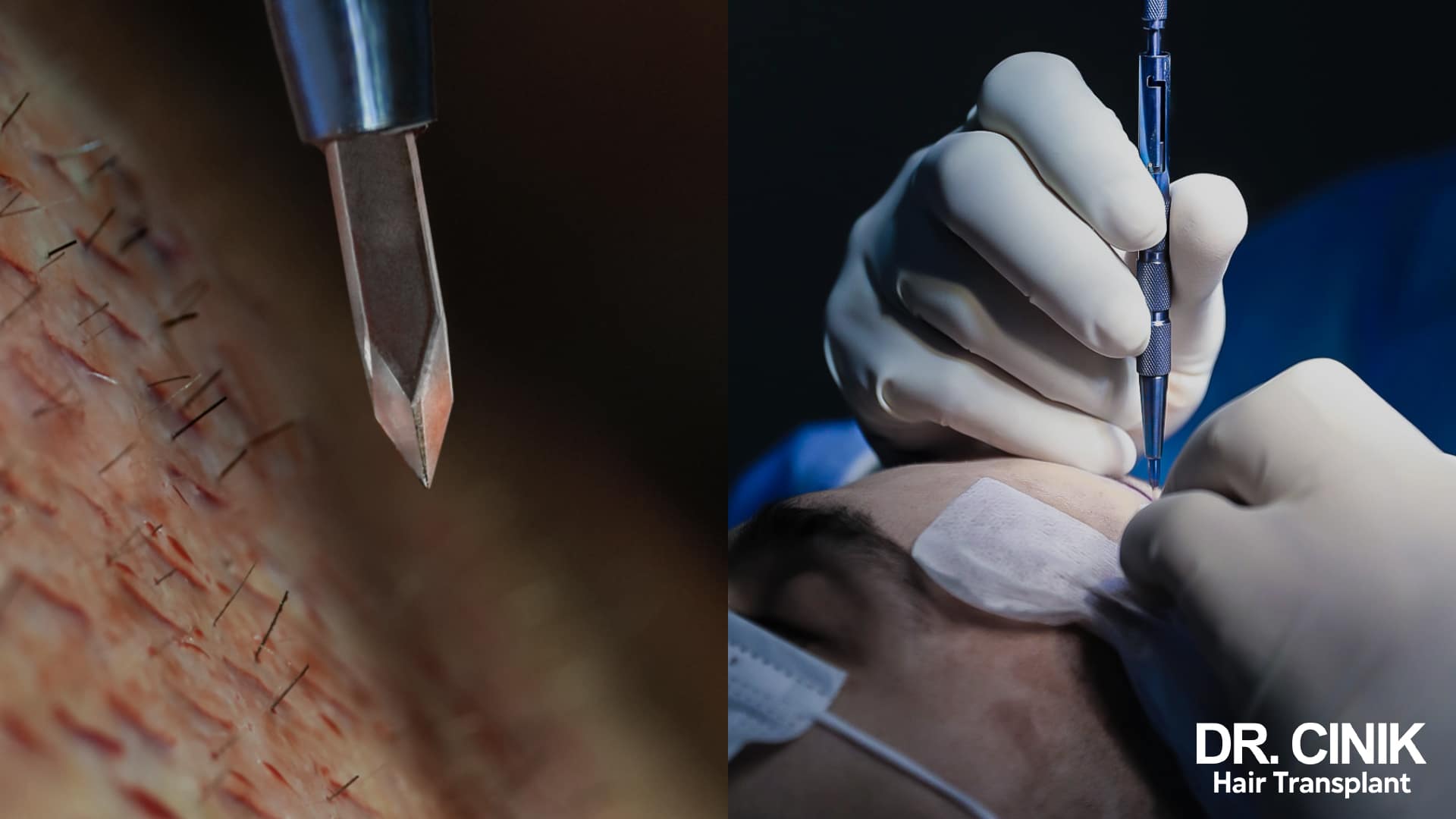 Close-up of the V-shaped bevelled tip of a sapphire blade held above an already incised scalp, beside a blade holder guided by a gloved hand