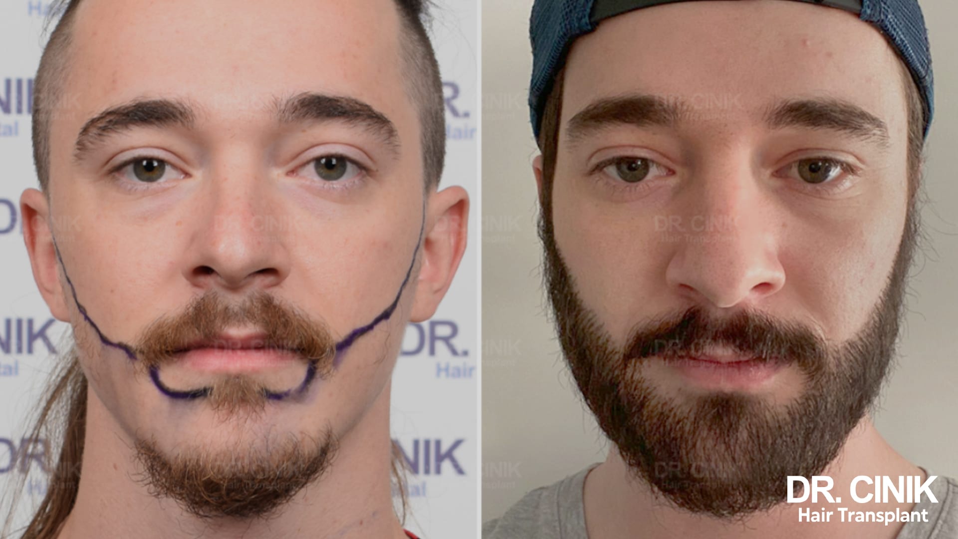 Avant après d'une greffe de barbe : à gauche le tracé préopératoire sur une barbe clairsemée, à droite une barbe fournie et homogène