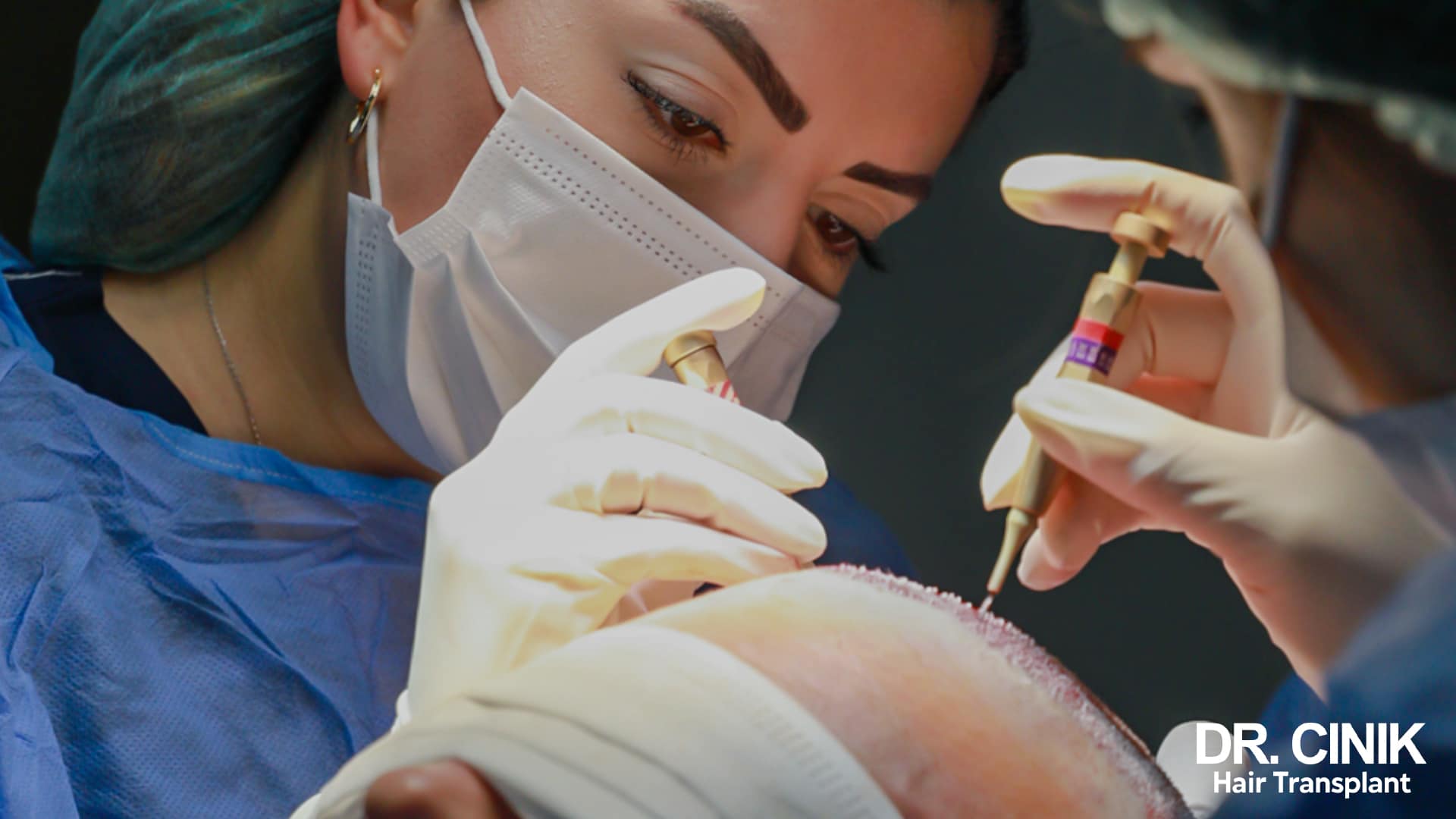Two gold-coloured implanter pens held above a shaved scalp during graft placement, handled by two masked practitioners