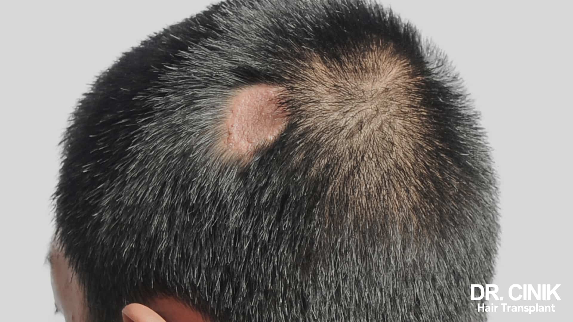 Circular patch of completely bare, smooth skin at the back of a head, surrounded by thick salt and pepper hair